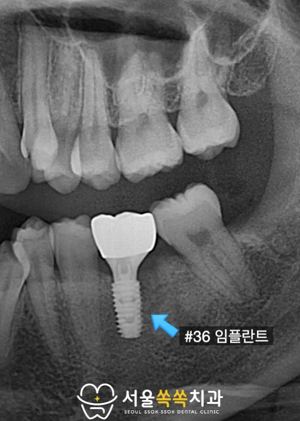 #36 임플란트 식립 후 파노라마 크롭 — 픽스처와 보철 결합 상태