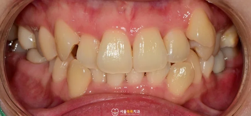 정면 초진 임상사진 — 립 리트랙터 적용한 상태에서 상하악 전체 치열 확인