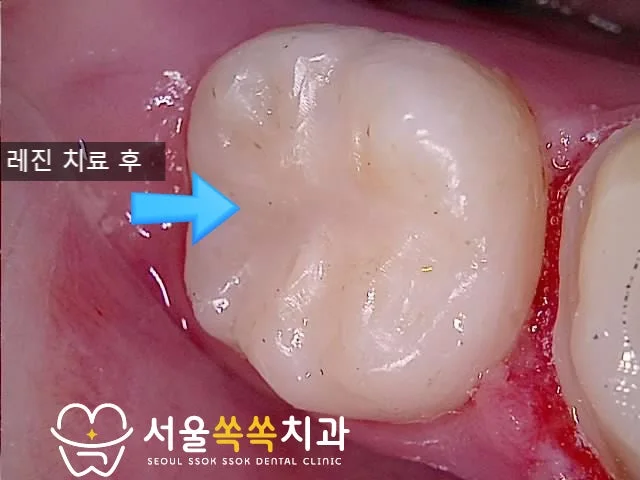충치 부위 레진 치료 후 — 자연치아색 수복 결과