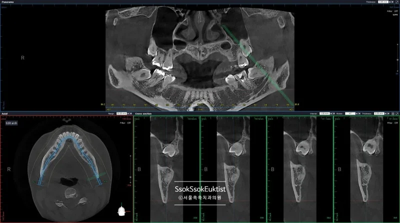 매복 사랑니와 하치조신경관 사이 거리를 3D 단면으로 확인한 CBCT 영상, 발치 방향과 안전 거리 평가용 자료