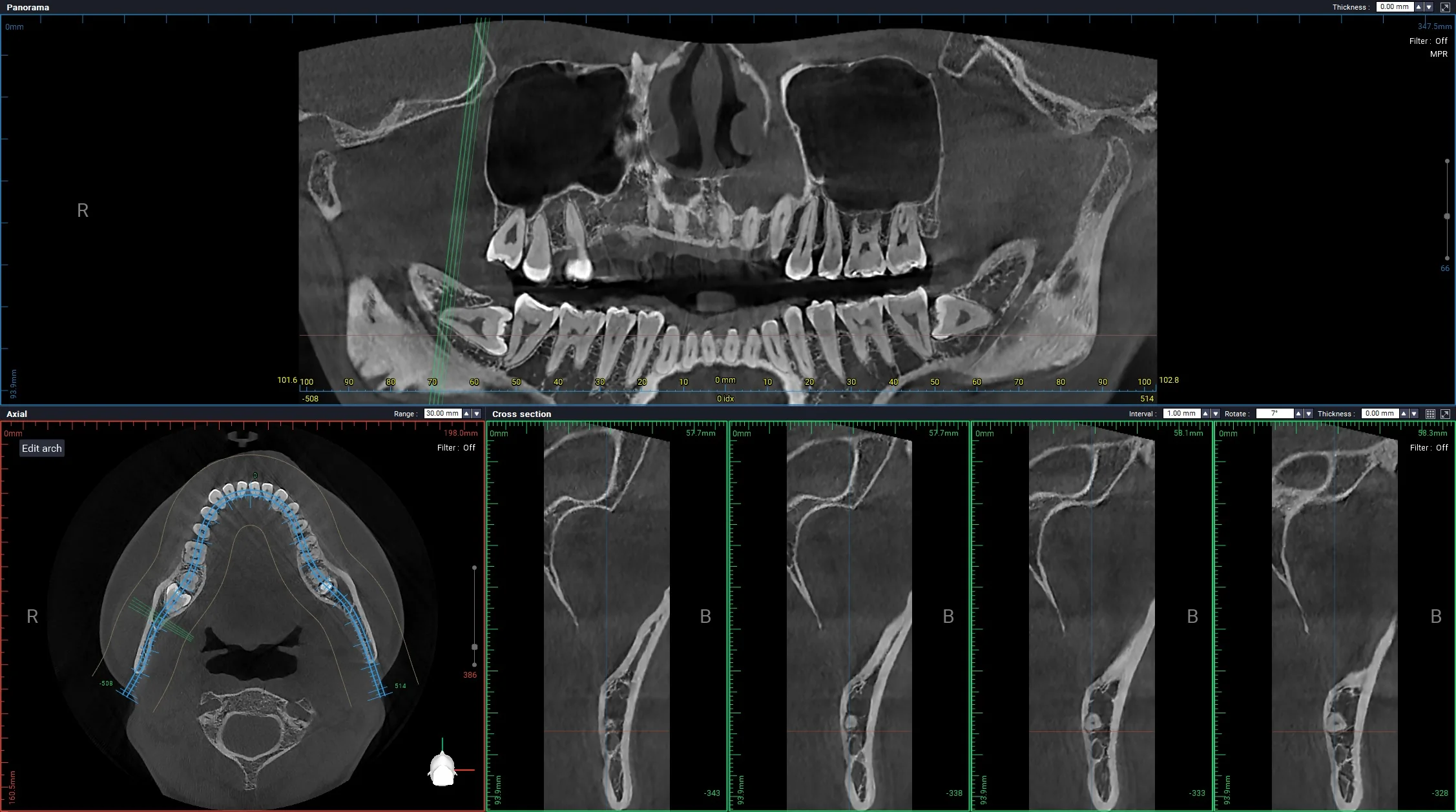 왼쪽 아래 매복 사랑니와 신경관 위치를 확인하기 위한 CBCT 단면 자료