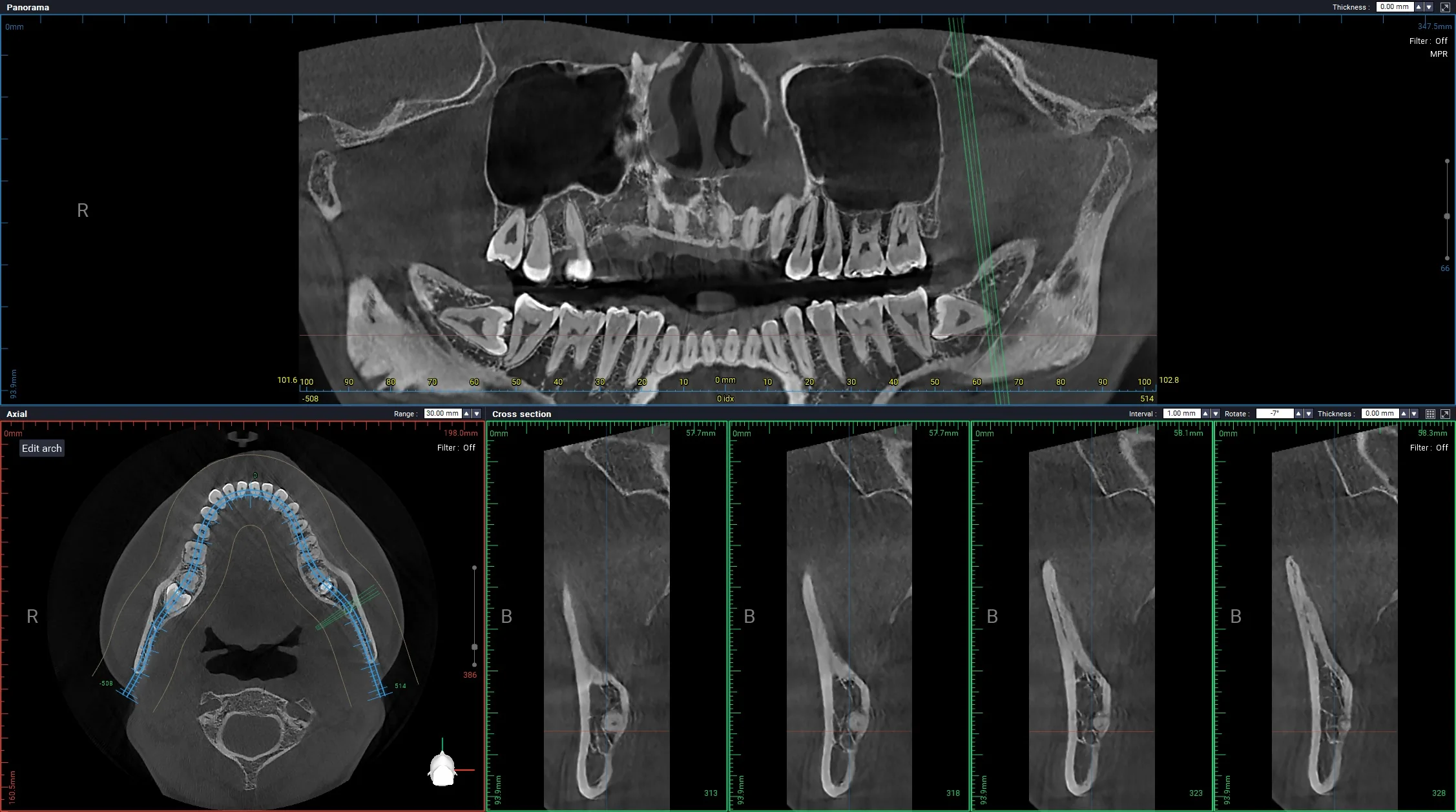 오른쪽 아래 매복 사랑니와 신경관의 거리를 확인한 CBCT 단면 자료