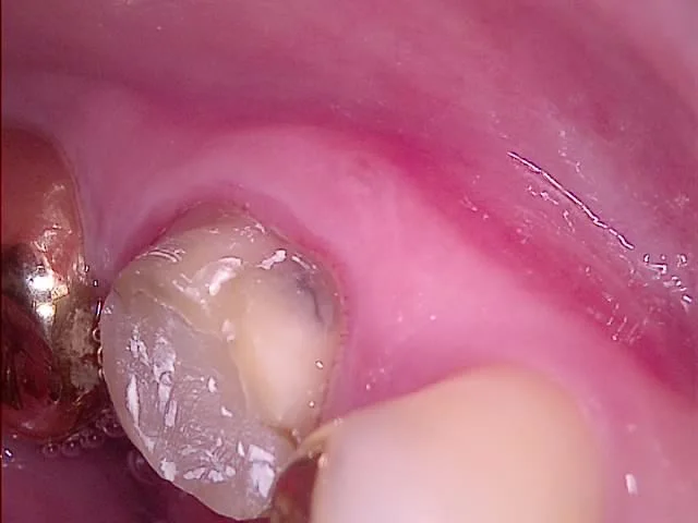 #36 buccal fistula 사라진 모습 — 재신경치료 회복 증거