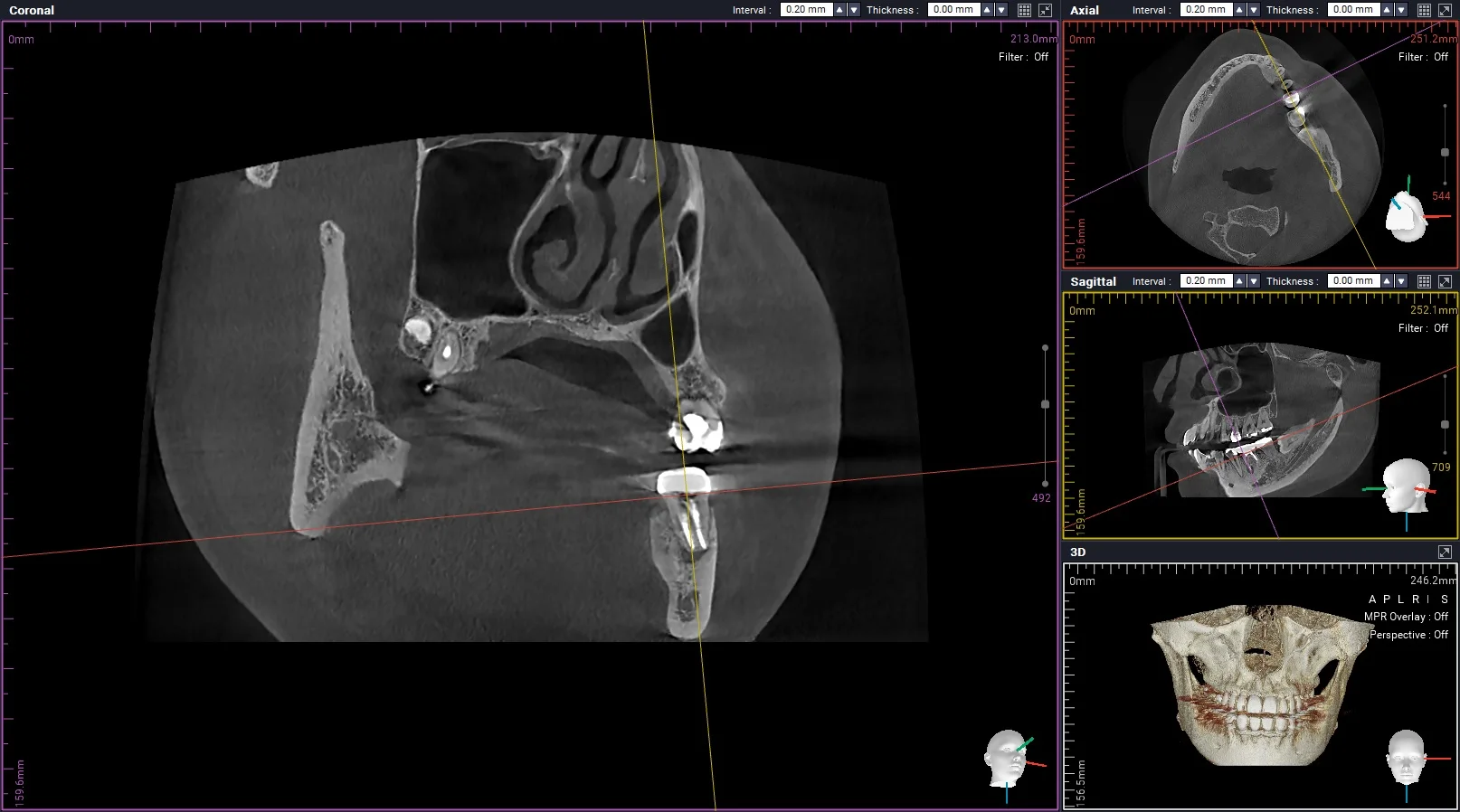 #36 재신경치료 진단 CBCT lesion 화면