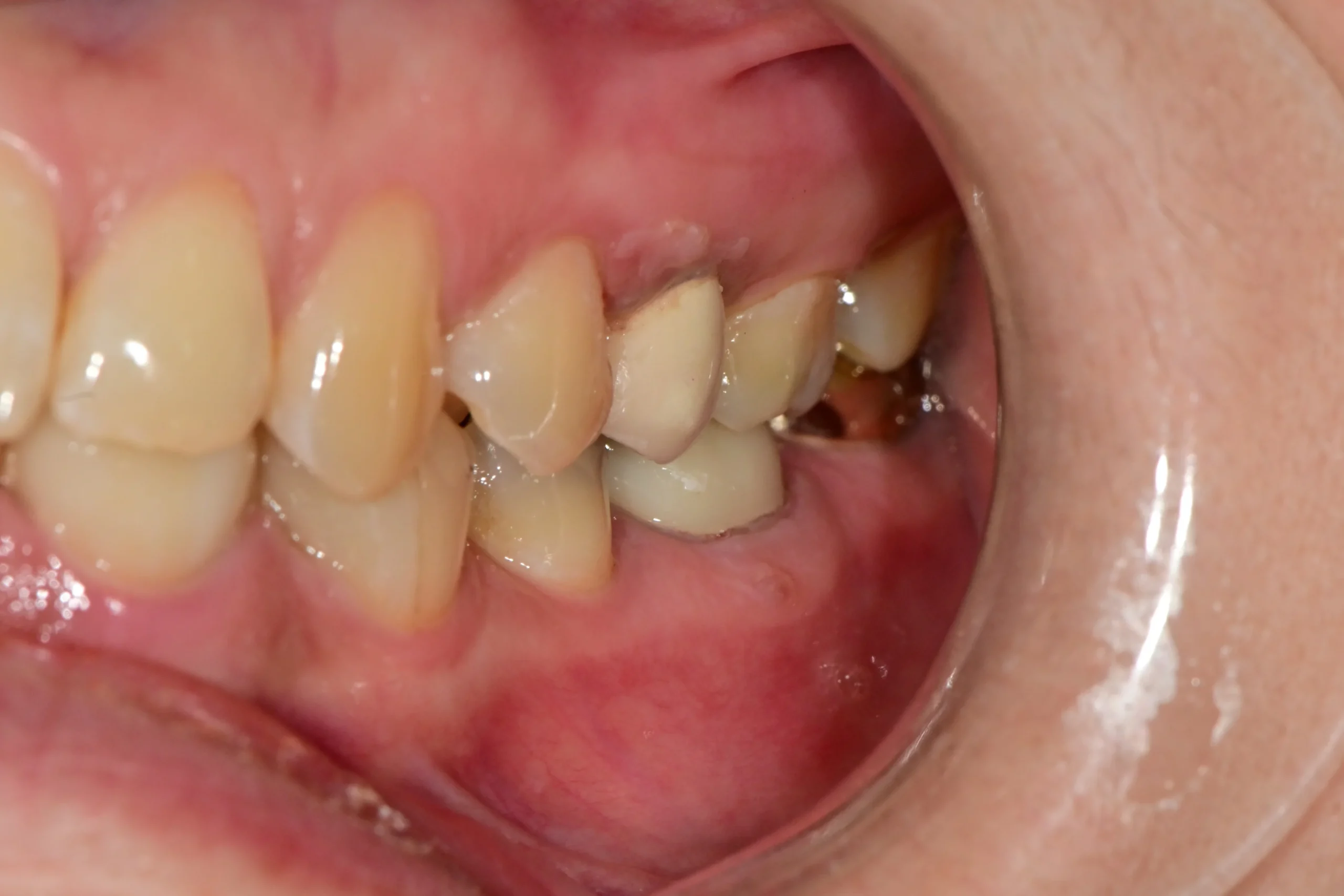 재신경치료 종결 좌측 측면 — fistula 사라진 후