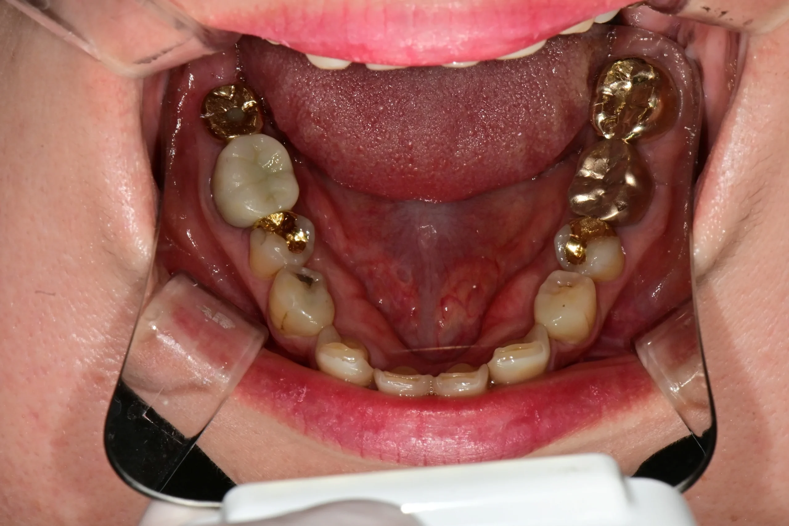 재신경치료 환자 초진 교합면 사진 — 잇몸 뾰루지(fistula) 확인