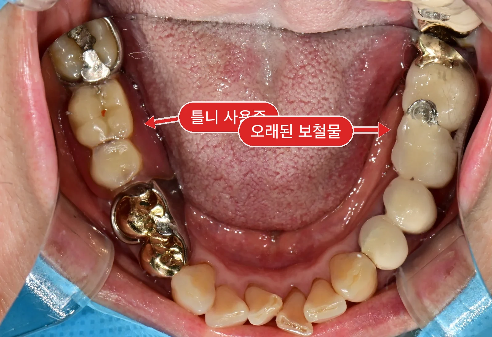 초진 하악 교합면 — 오른쪽 아래 결손
