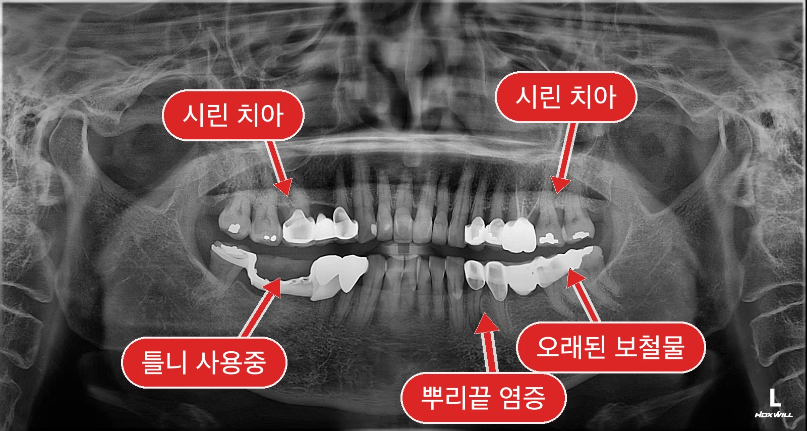 초진 전체 파노라마 — 결손치·오래된 보철물