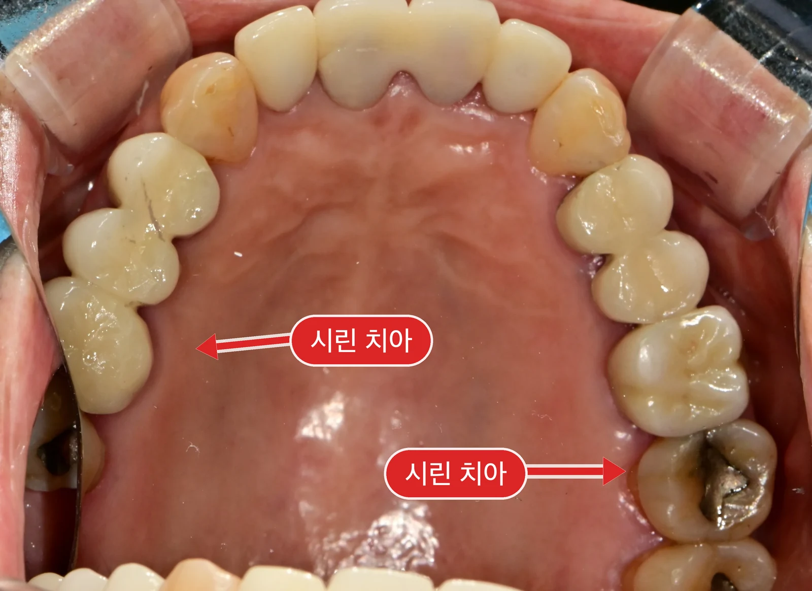 초진 구강내 사진