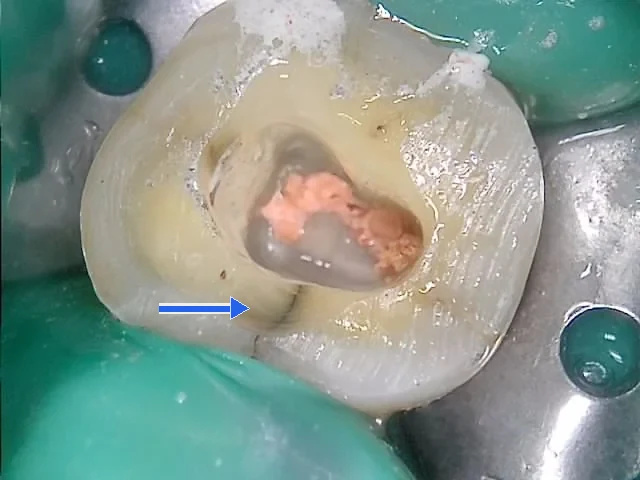 신경치료 과정 사진