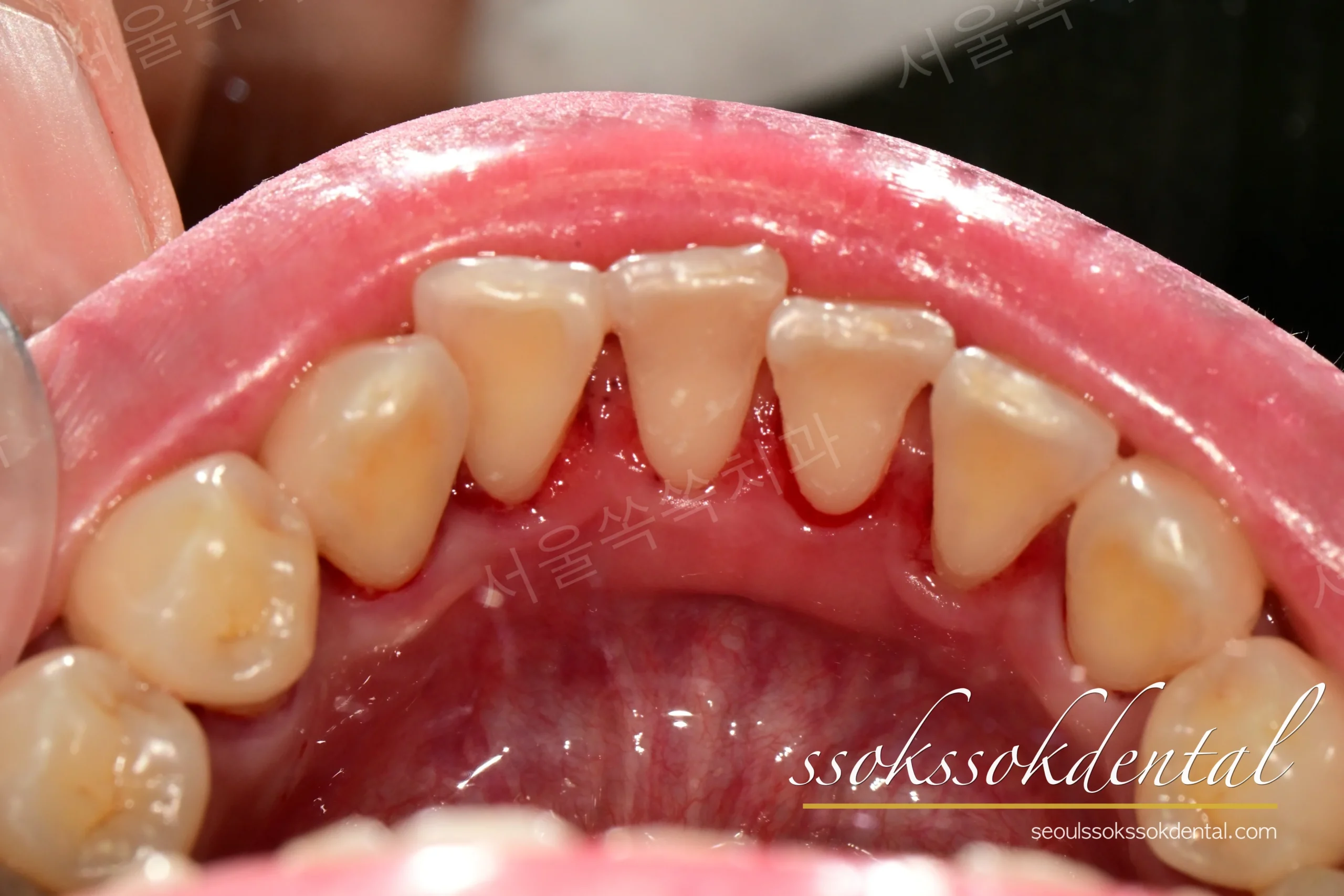 아래 앞니 안쪽 설측 치석 제거 후 정리된 사진