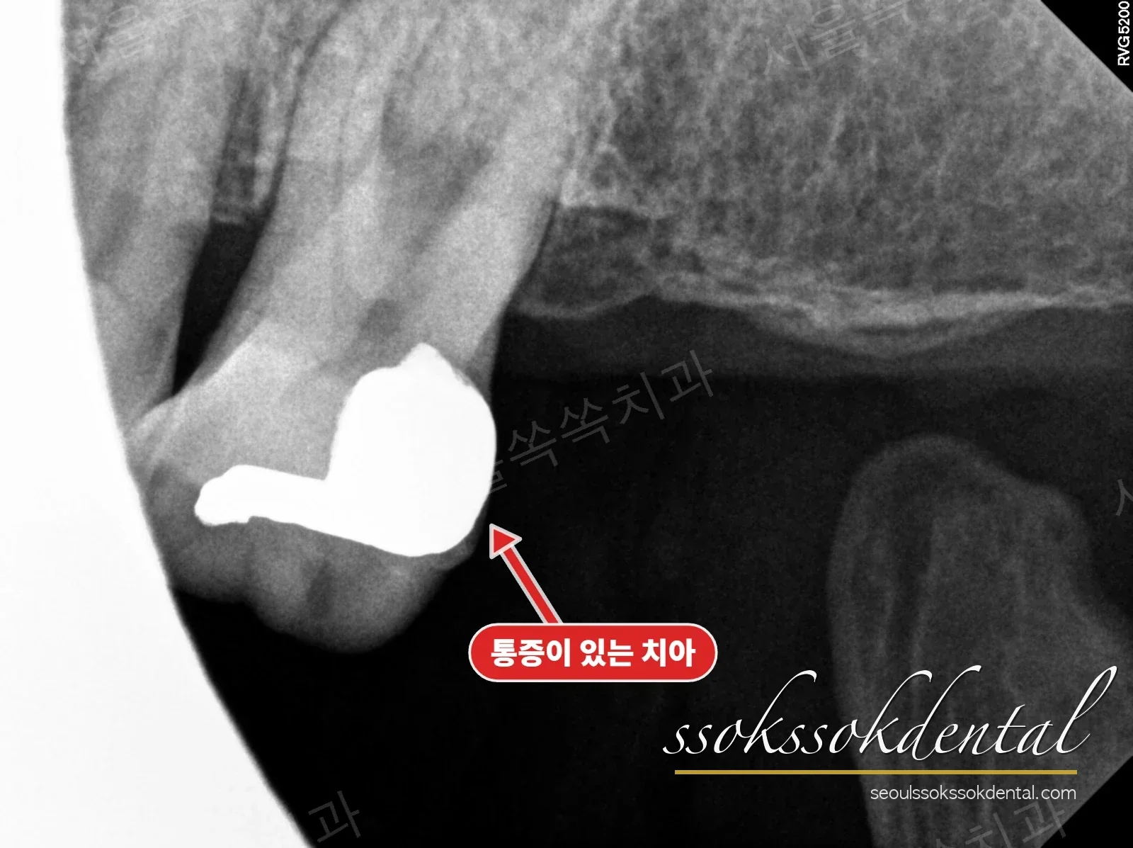 #26 치근단 방사선 치료 전