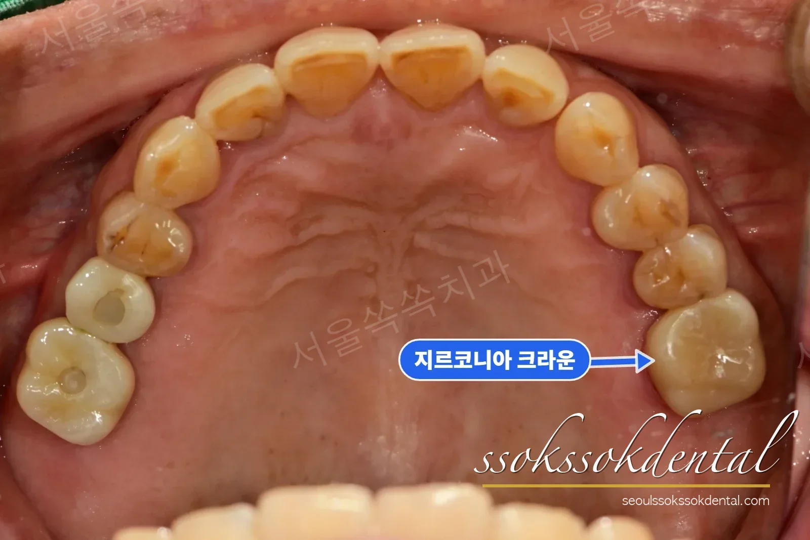 위턱 교합면 치료 후 — 새 크라운