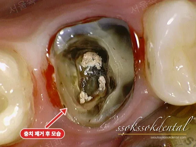 골드크라운 제거 후 드러난 충치 — 잇몸 아래까지 진행