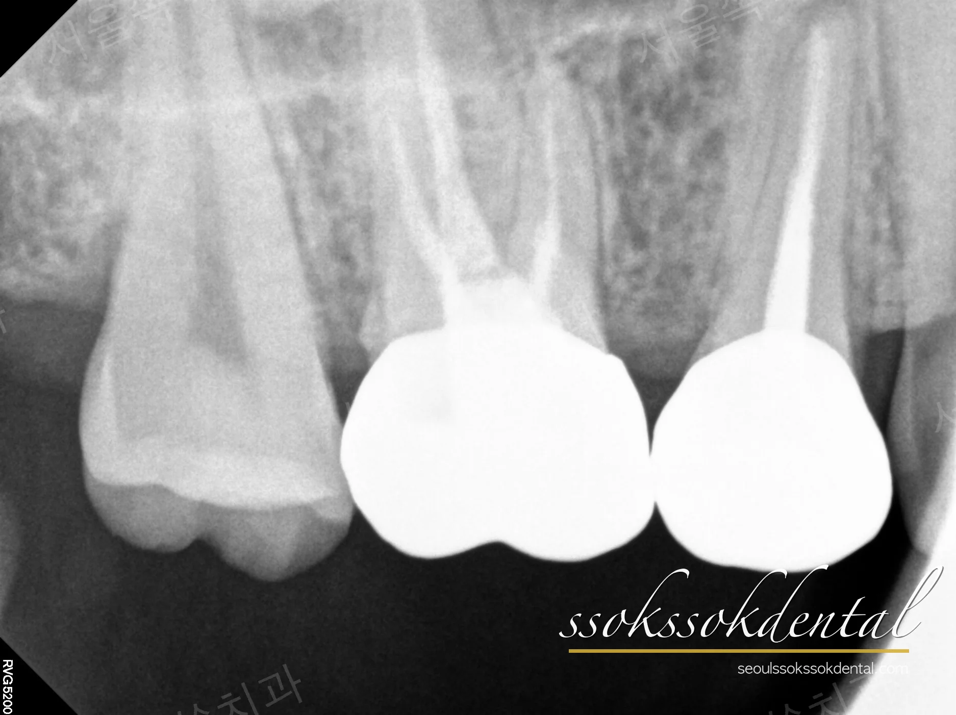 세팅 후 치근단 X-ray