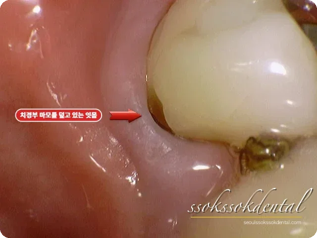 아래 어금니 치경부 병소 치료 전 - 잇몸이 병소를 덮고 있음