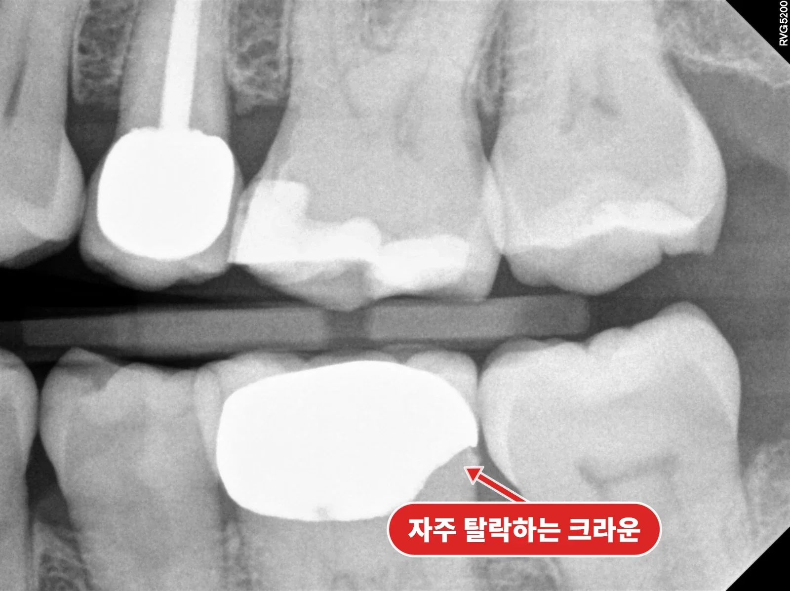 방사선 사진, 잇몸 아래 깊은 어금니 충치 확인