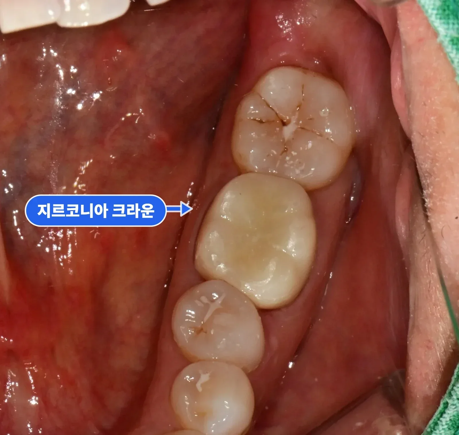 치료 후 아래턱 교합면, 어금니 보철과 잇몸 안정