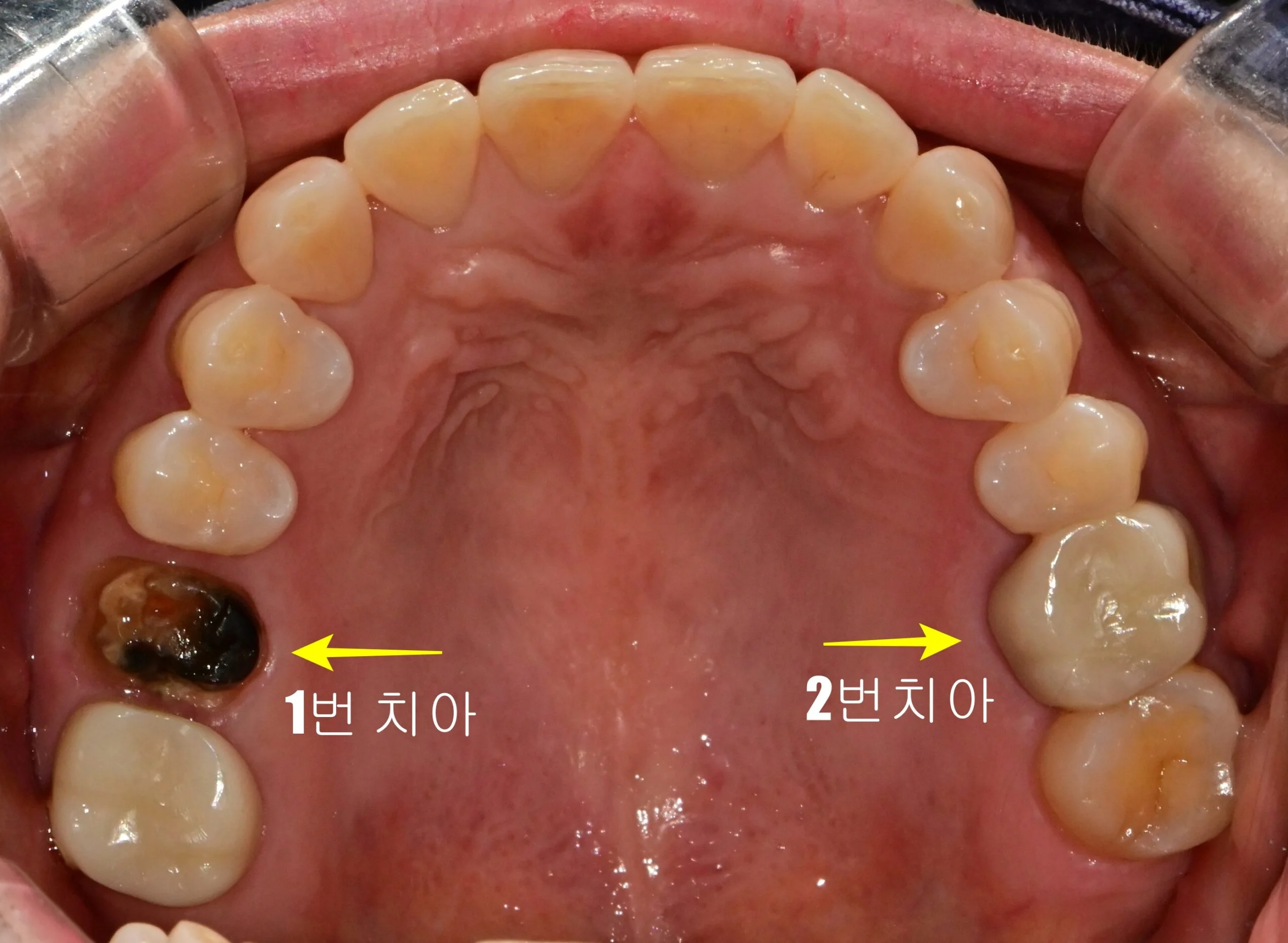 마곡 치과 자연치아 살리기 초진 구강 내 모습