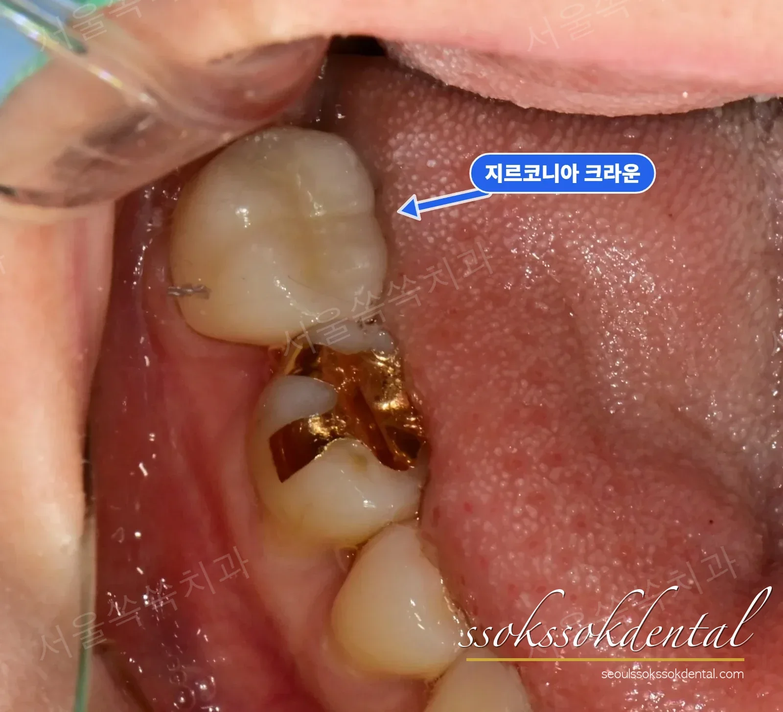 아래턱 교합면 치료 후 — 새 크라운 자리