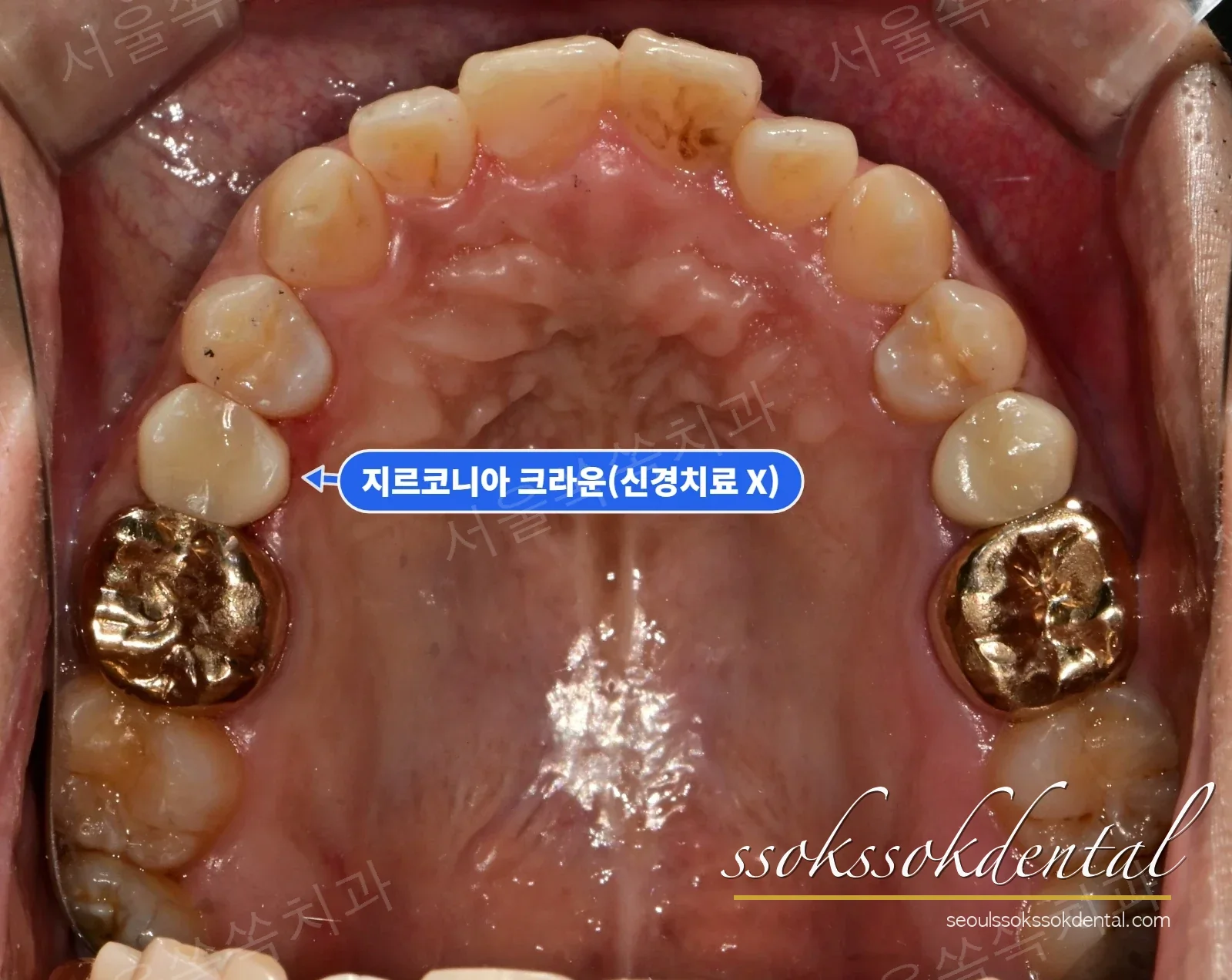 위턱 교합면 치료 후 — #15 지르코니아 크라운 세팅
