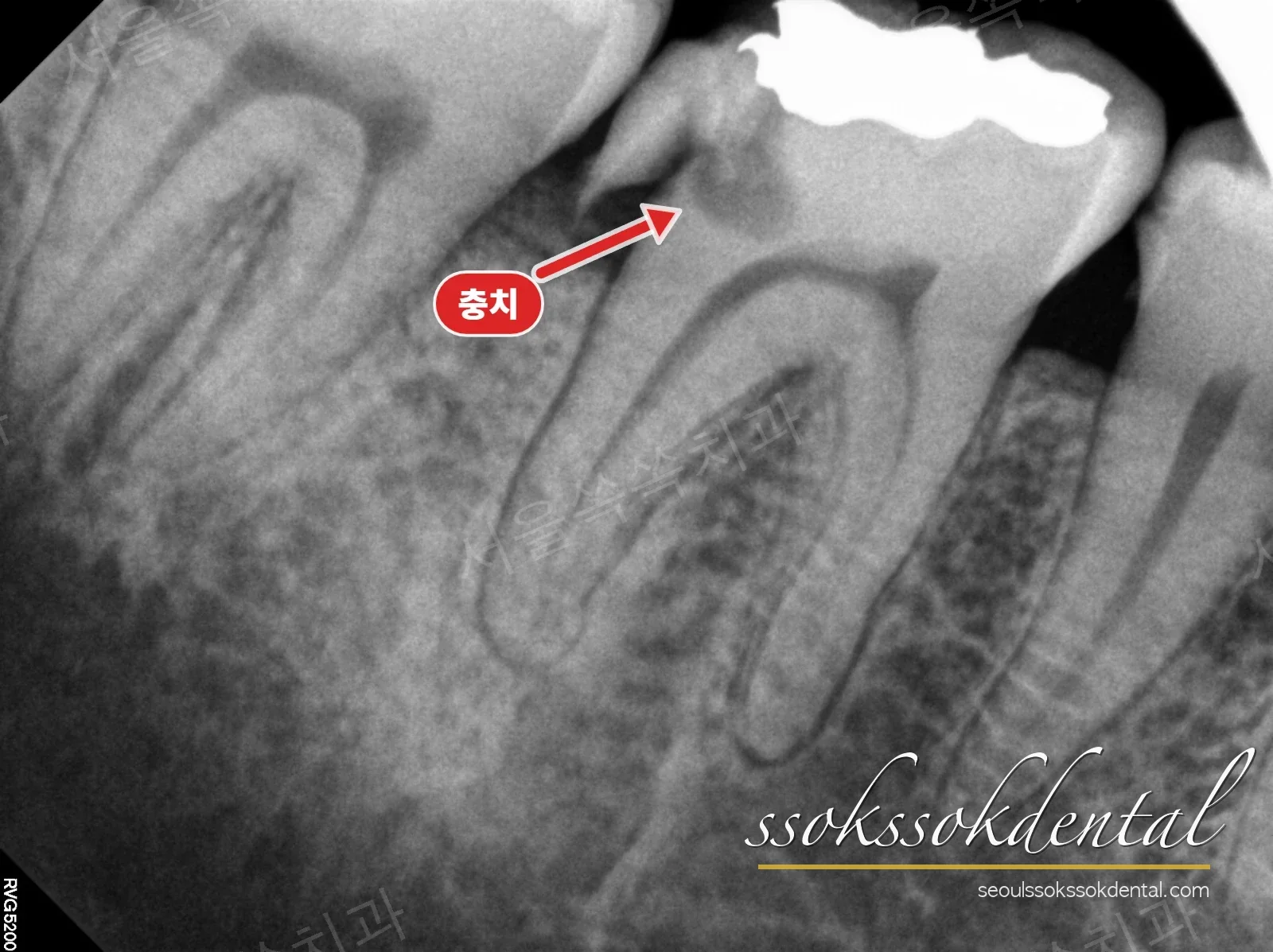 #46 신경치료 시작 전 치근단 방사선