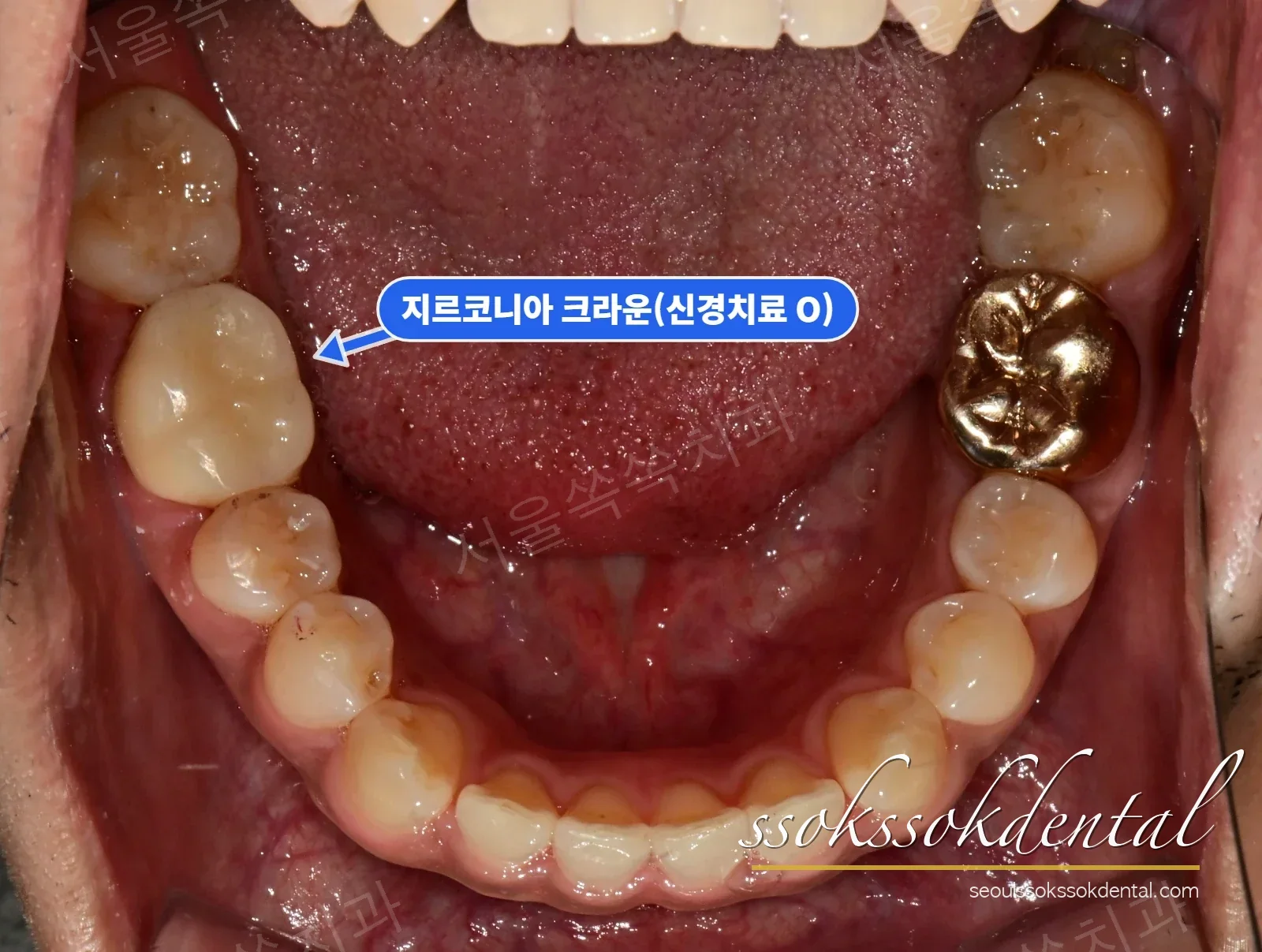 아래턱 교합면 치료 후 — #46 크라운 세팅