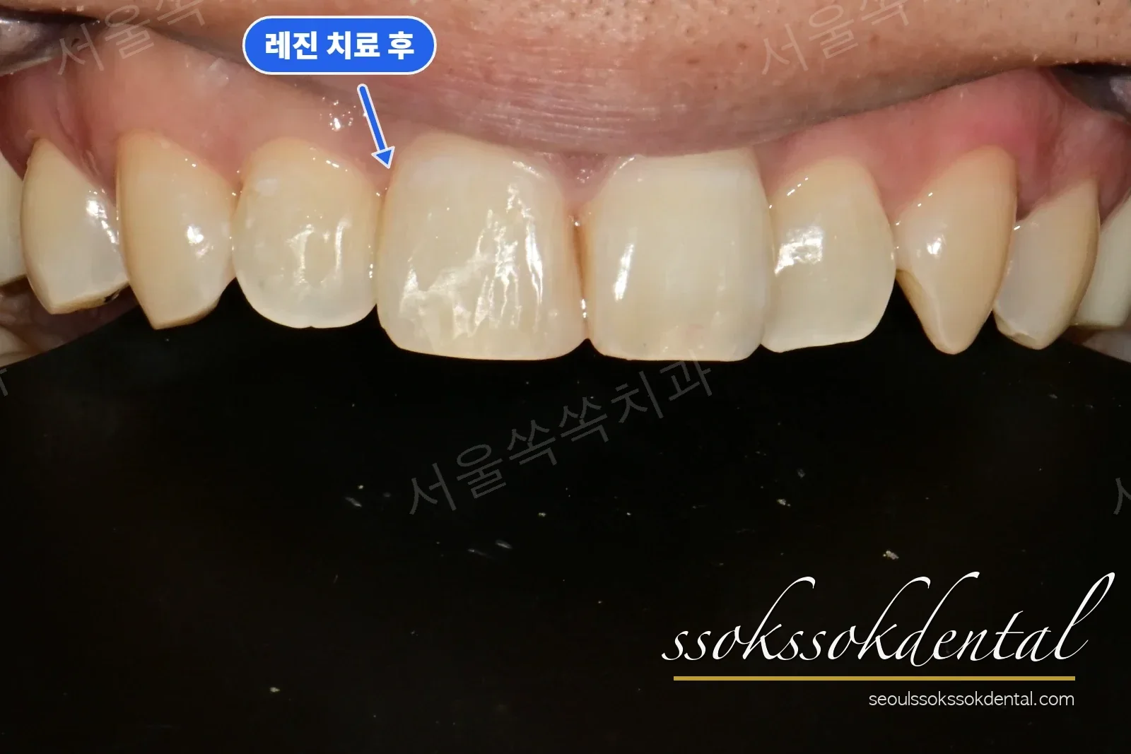 앞니 전치부 레진 치료 후