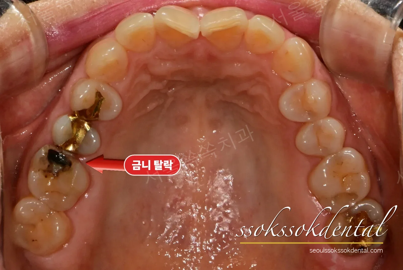 위쪽 어금니 교합면 — 금 인레이가 빠진 자리와 옆 치아의 오래된 인레이