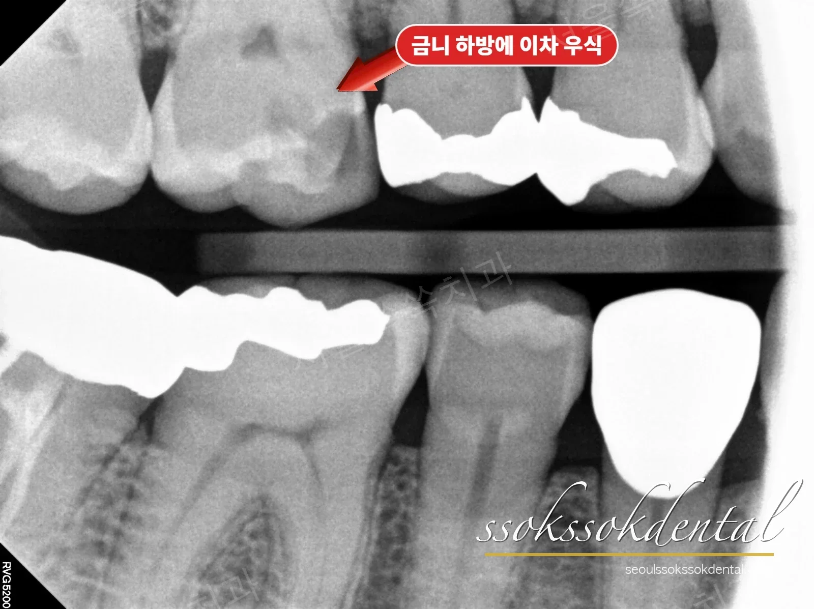 교익 방사선 — 빠진 어금니 아래로 깊게 내려간 충치