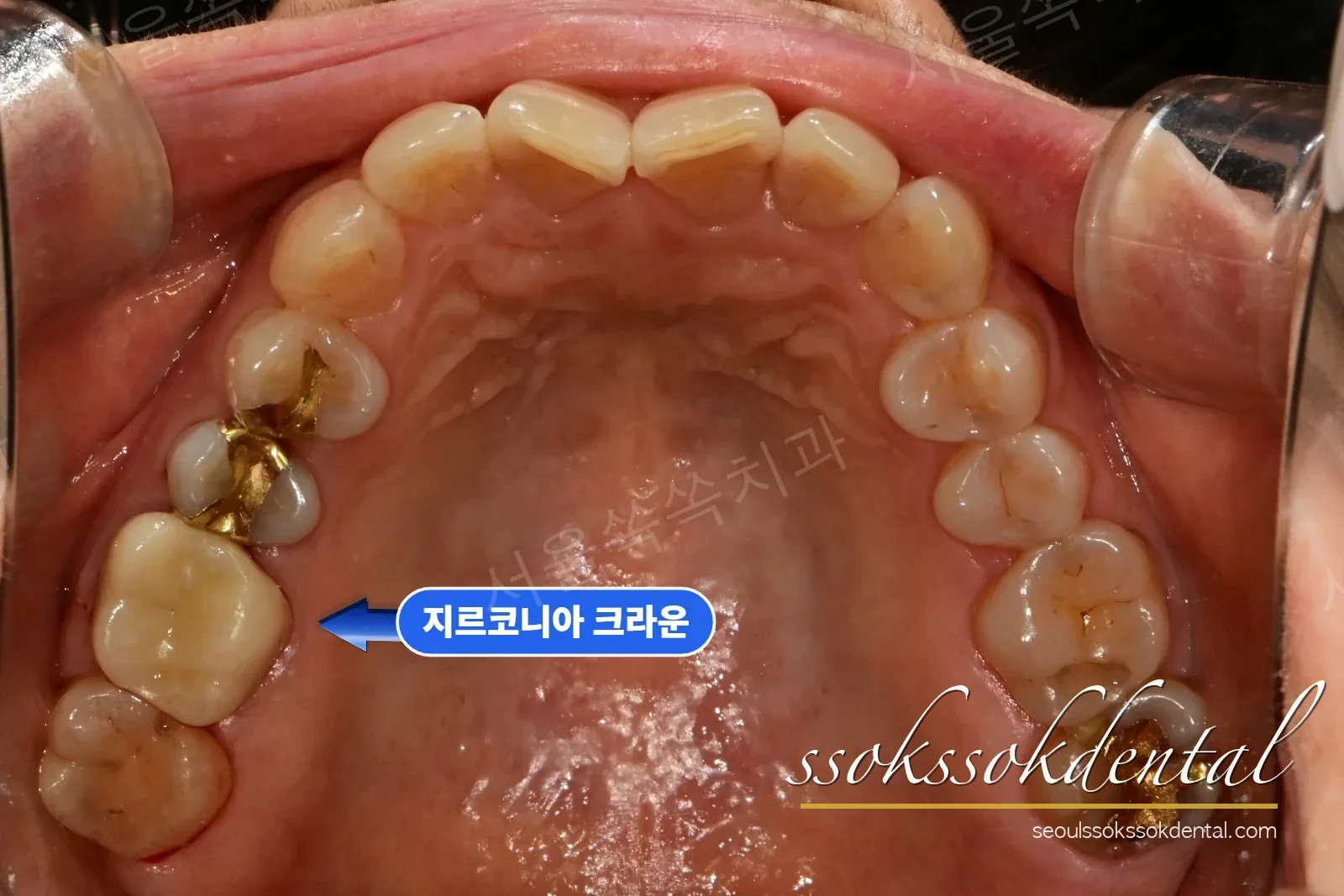 지르코니아 크라운을 끼운 어금니 최종 모습
