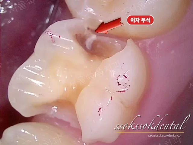 충치를 제거하고 세라믹 인레이가 들어갈 자리를 다듬은 어금니