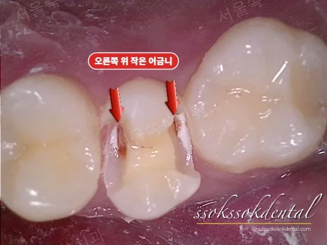 #15 치료 중 확인한 숨은 충치