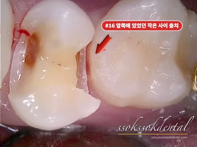 치아 사이 숨은 충치 확인