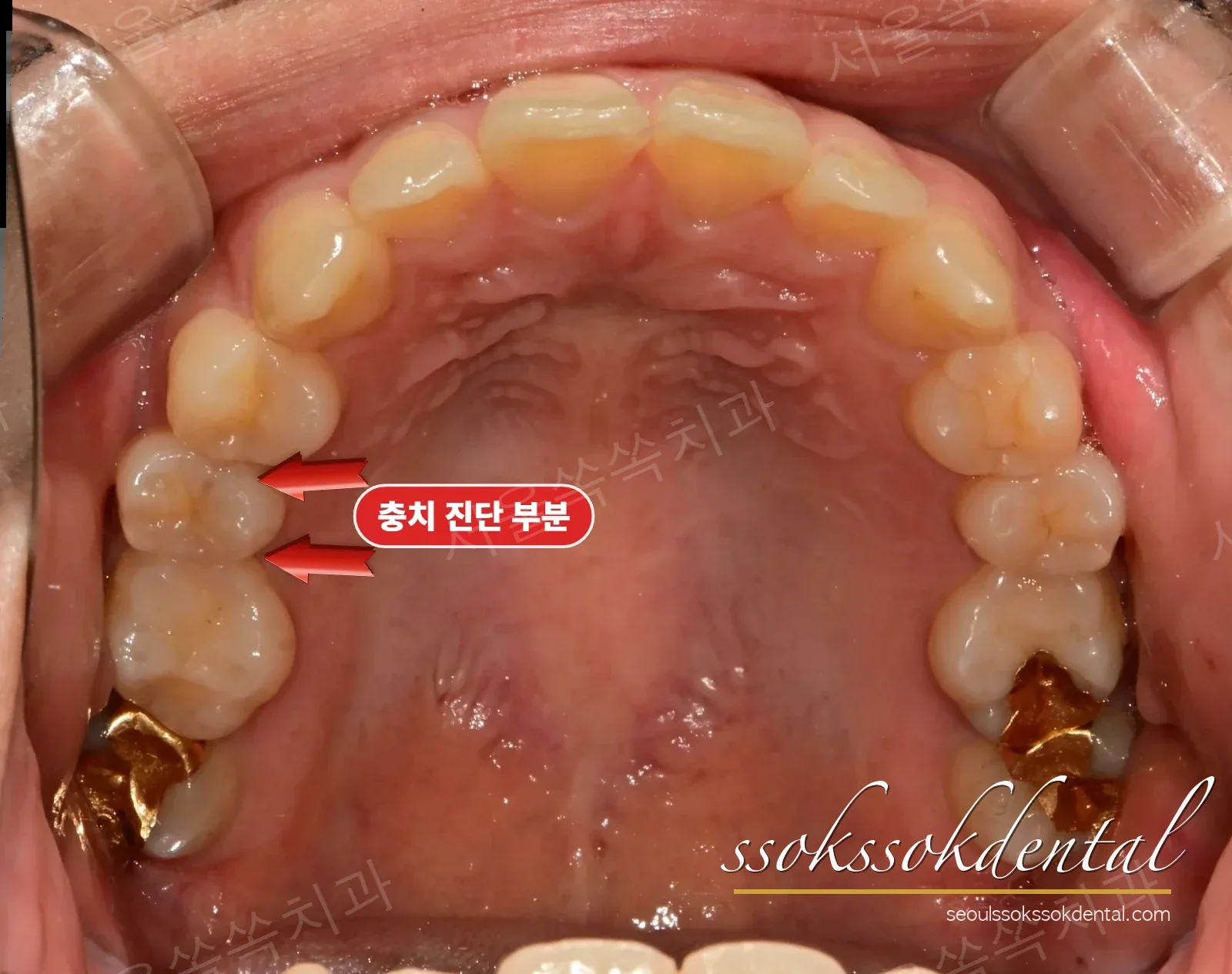 상악 교합면 치료 전
