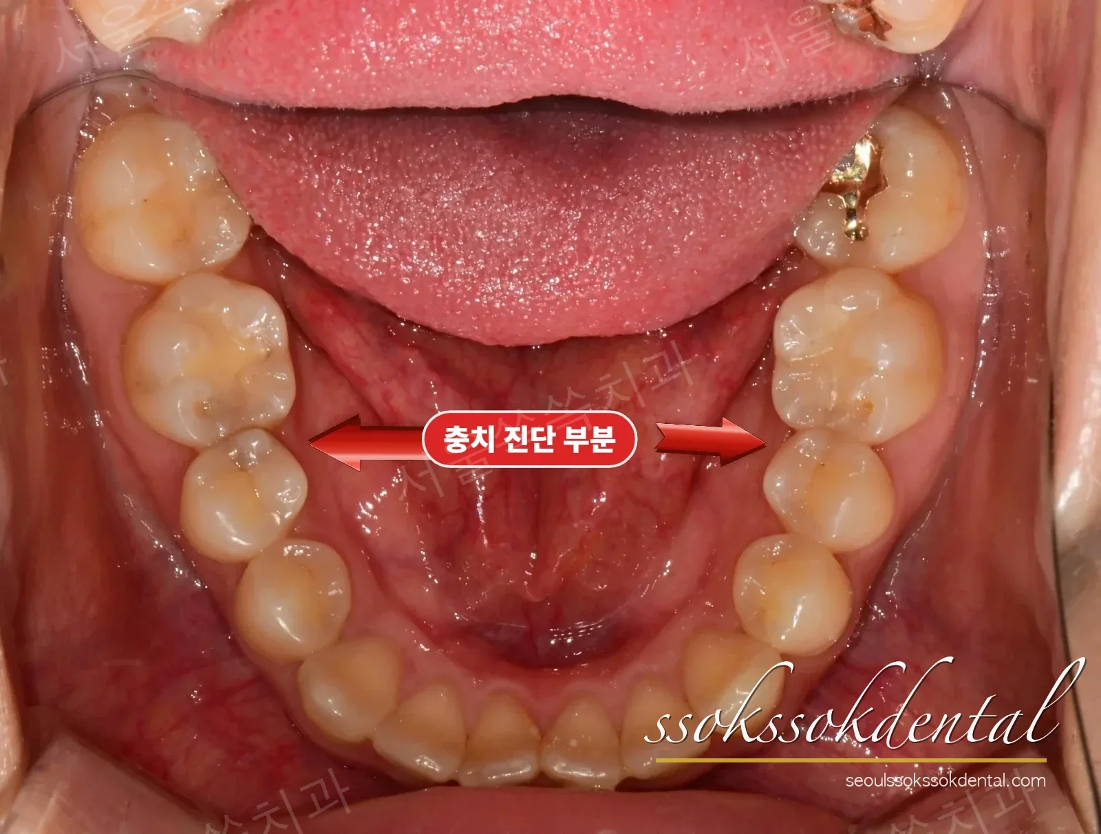 하악 교합면 치료 전