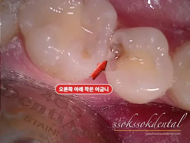 #45 치료 중 확인한 숨은 충치