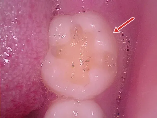 충치 제거 후 인레이 자리를 다듬은 모습