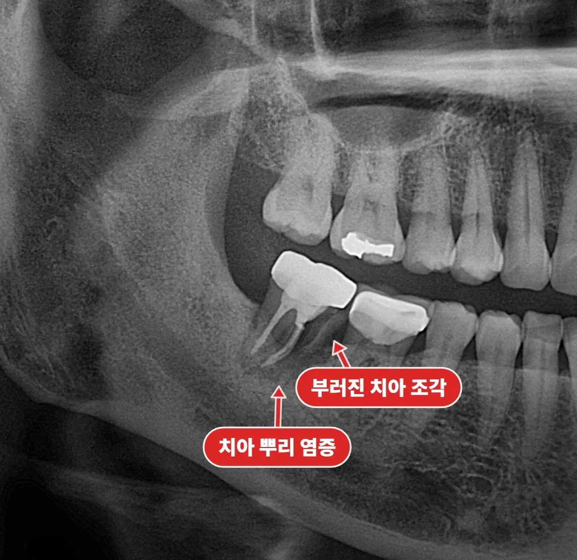 초진 파노라마, 오른쪽 아래 어금니 부위 문제 확인
