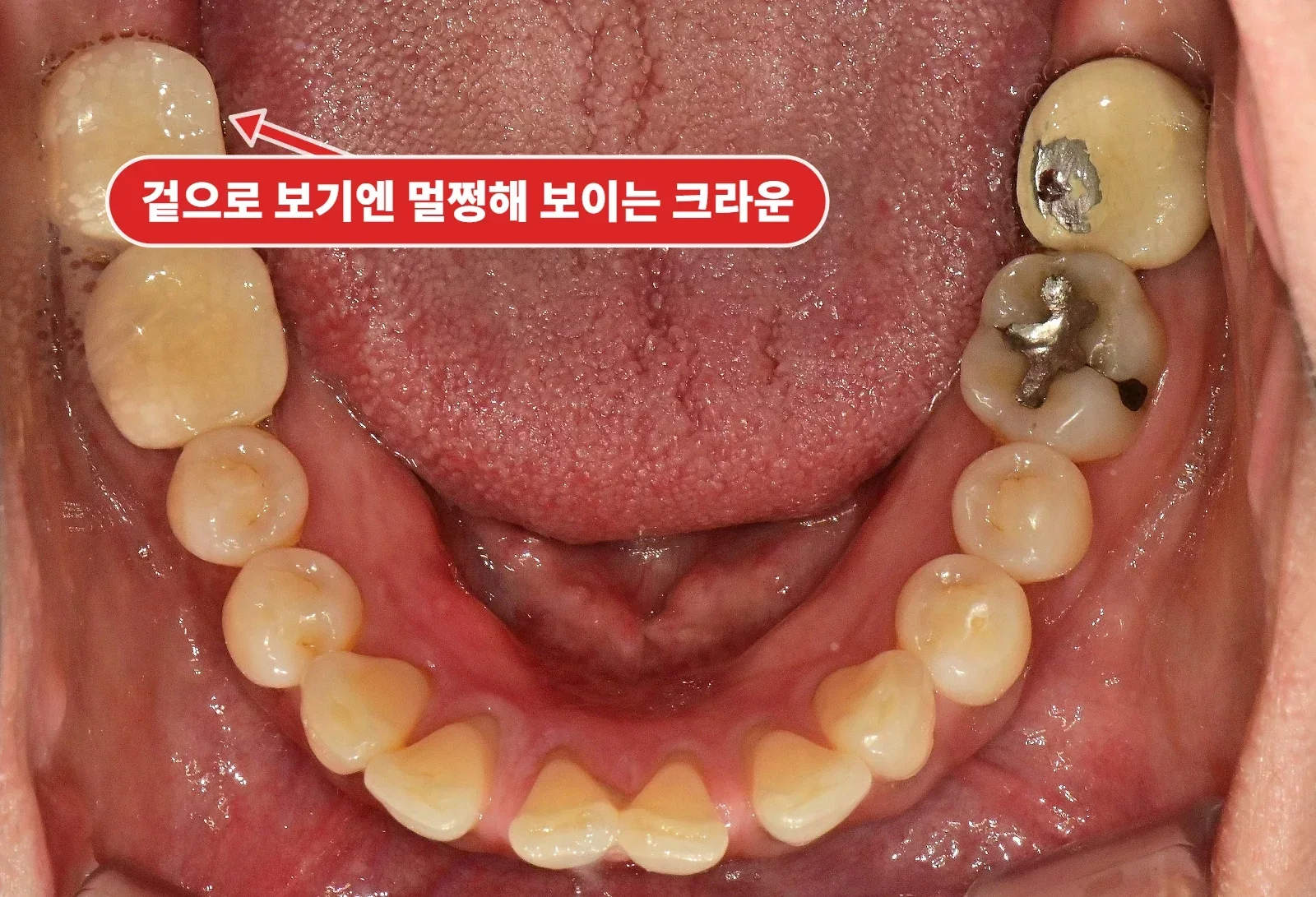 치료 전 아래턱 교합면, 비어 있는 어금니 자리