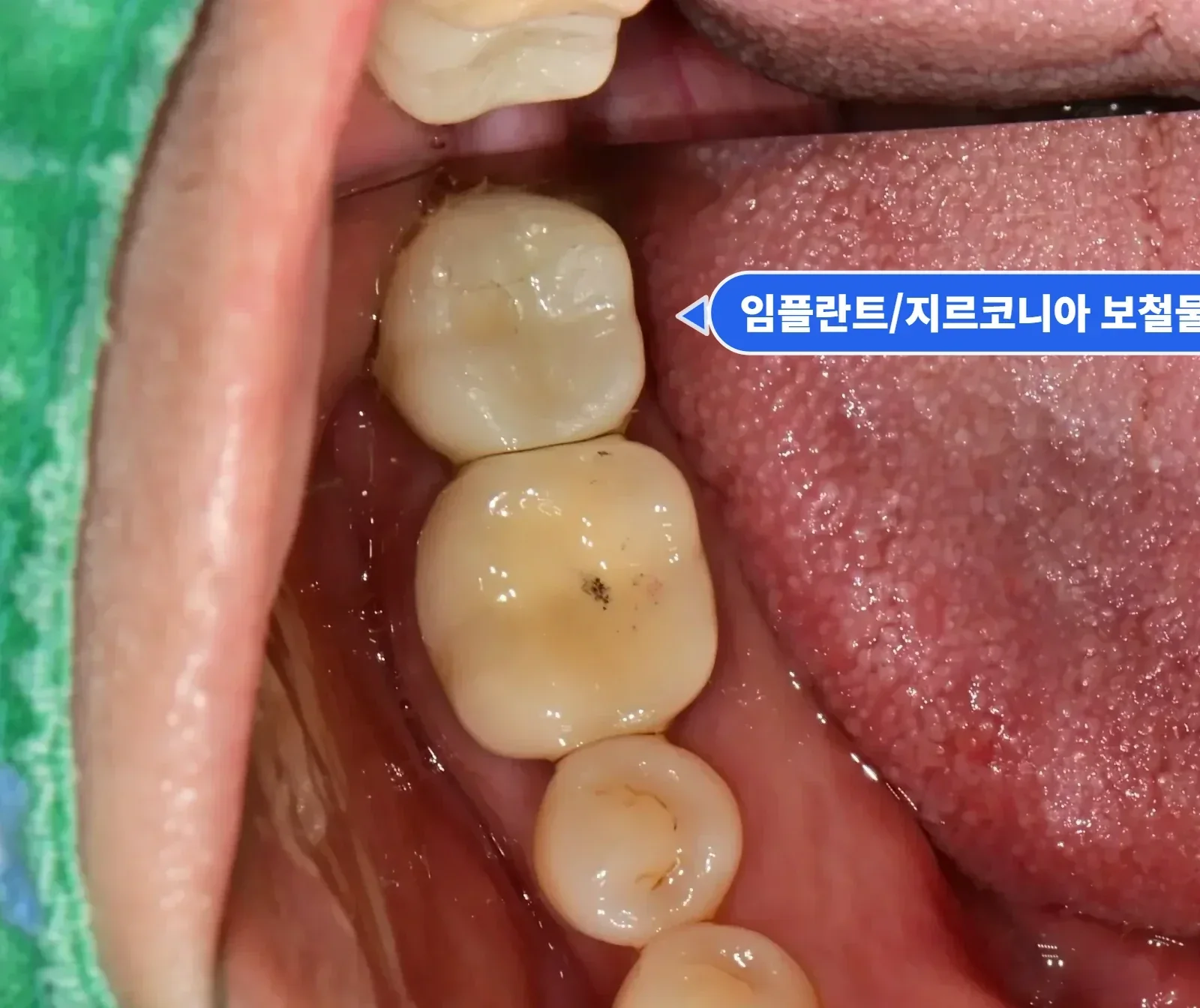 치료 후 아래턱 교합면, 어금니 임플란트 지르코니아 크라운
