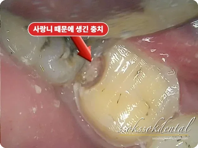 오른쪽 아래 어금니 옆면 충치 확인