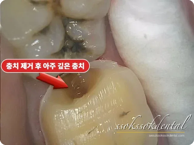 오른쪽 아래 어금니 충치 제거 후
