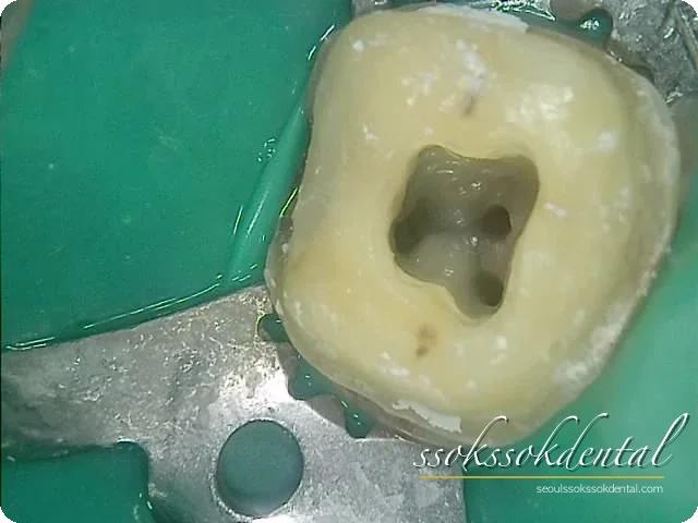 오른쪽 아래 어금니 당일 신경치료 중