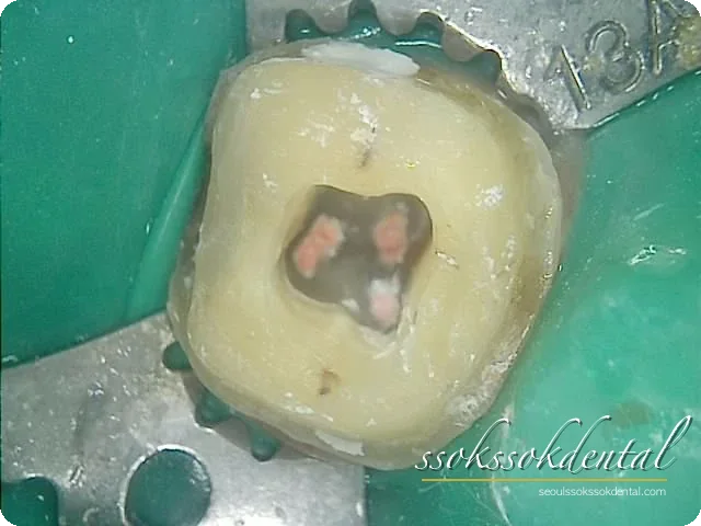 오른쪽 아래 어금니 러버댐 신경치료