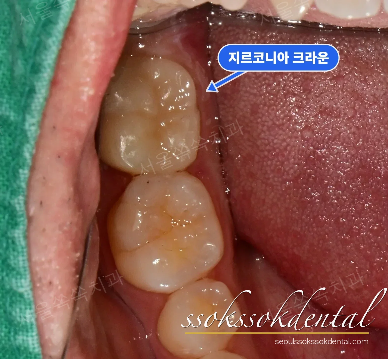 지르코니아 크라운 장착 후 하악 교합면