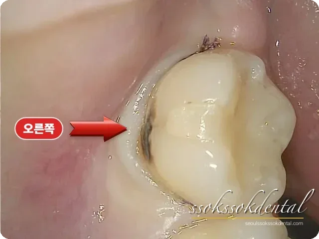 치경부 마모·결손 치료 전 근접 사진