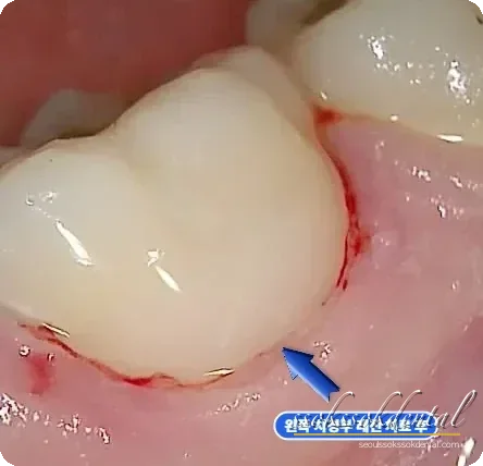 반대측 치경부 레진 충전 후