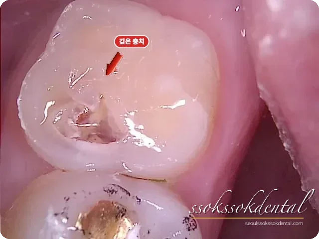 좌측 위 큰어금니의 깊은 충치 확인