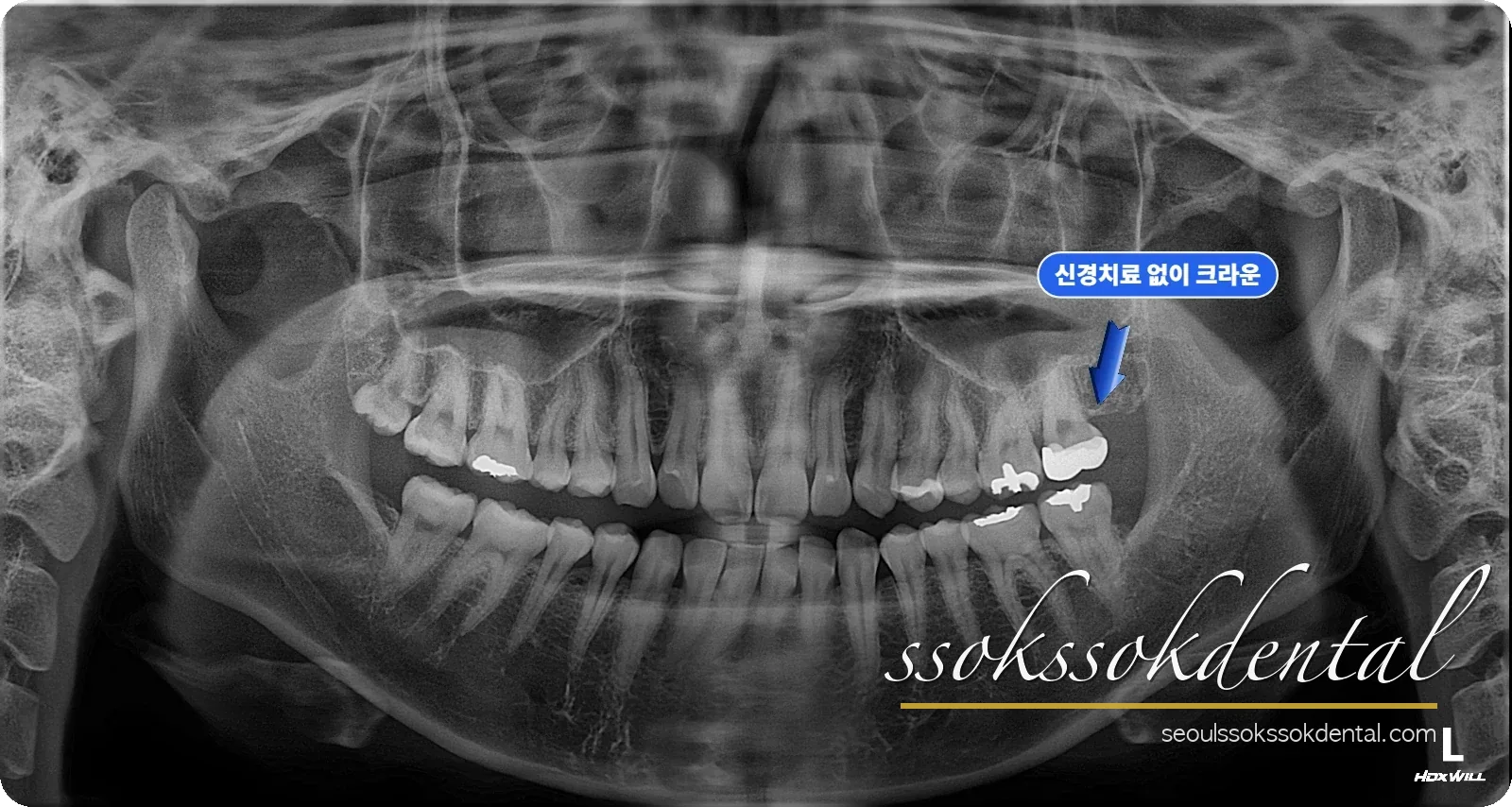 치료를 마무리한 종결 파노라마